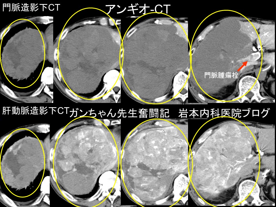CT　before